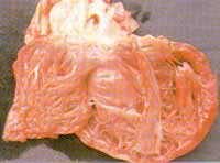 Aspecto macroscópico del  ventrículo izquierdo dilatado Aspecto macroscópico del  ventrículo izquierdo dilatado