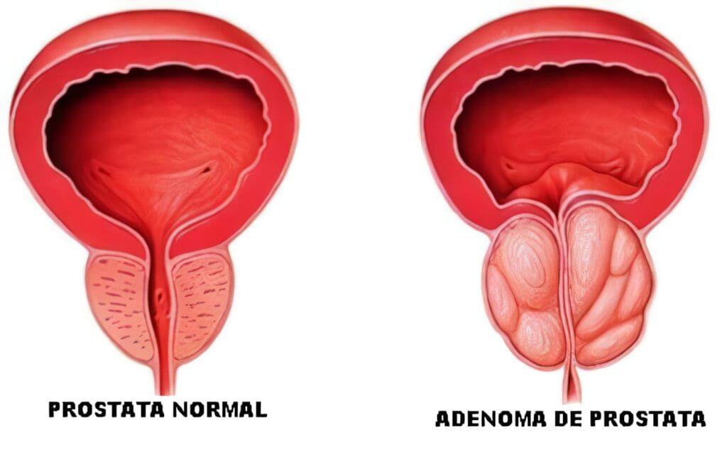 Síndrome Prostático, Tratamiento