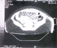 Tac abdominal. S.N. paciente de 32 años, con un lupus que se inició a los 18 años. Tac abdominal. S.N. paciente de 32 años, con un lupus que se inició a los 18 años.