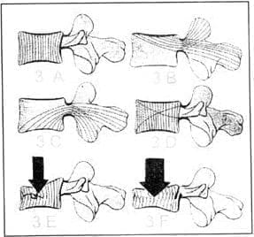 Corte sagital de vértebras con esquematización de trabéculas. Corte sagital de vértebras con esquematización de trabéculas.