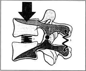 Representación de unidad vertebral como palanca de primer grado Representación de unidad vertebral como palanca de primer grado