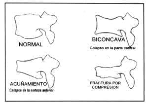 Esquemas de representación radiológica del compromiso vertebral Esquemas de representación radiológica del compromiso vertebral