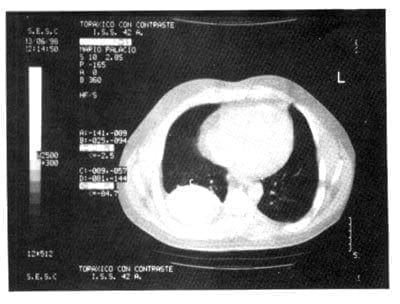 TAC de Tórax: Se evidencia masa redondeada de 8 cm de diámetro, ubicada en el espacio pleural derecho, parte inferior