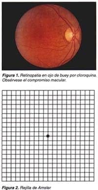 Retinopatia del ojo de buey y rejilla amsler