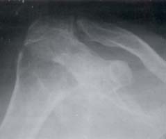 Subluxación de la cabeza humeral Subluxación de la cabeza humeral