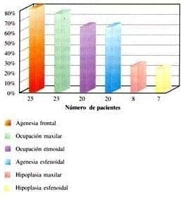 Hallazgos en senos paranasales con fibrosis quística Hallazgos en senos paranasales con fibrosis quística