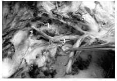 Seno cavernoso derecho