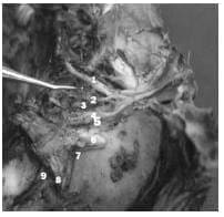 Seno cavernoso derecho