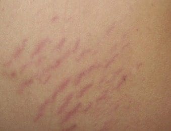 Estrías recientes en la piel