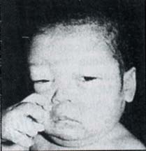 Paciente con síndrome nefrótico Paciente con síndrome nefrótico