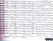 Dolor Abdominal Recurrente