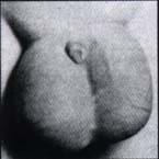 Edema escrotal  Edema escrotal