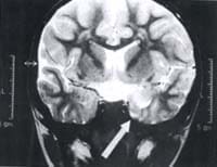 Zona del hipocampo con disminución global