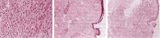 Pseudotumorinflamatorio en Vías Aérea 