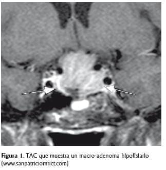 TAC de un macro adenoma