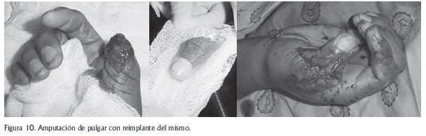 Amputacion de pulgar