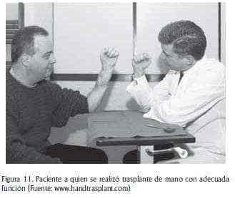 Trasplante de mano Trasplante de mano