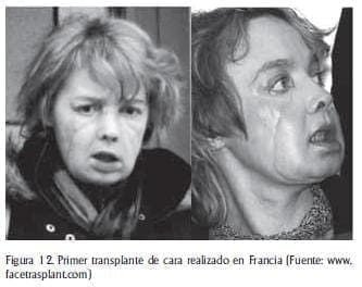 Transplante de cara Transplante de cara