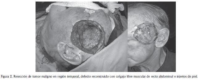 Tumor maligno en region temporal Tumor maligno en region temporal