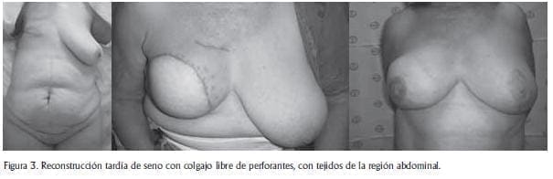 Reconstrucción tardía de seno Reconstrucción tardía de seno
