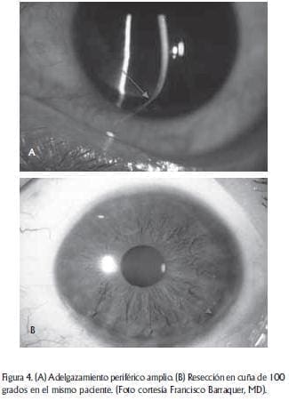 Adelgazamiento periferico amplio Adelgazamiento periferico amplio