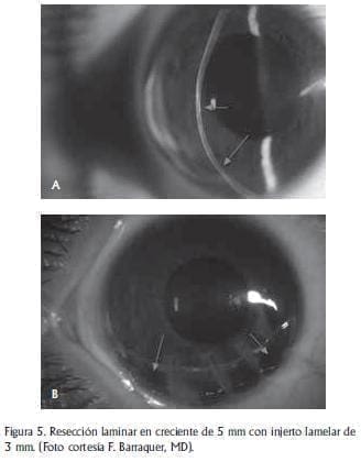 Resección laminar en creciente Resección laminar en creciente