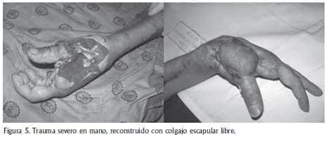 Trauma severo de mano Trauma severo de mano