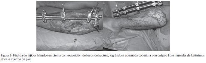 Perdida de tejido blando Perdida de tejido blando