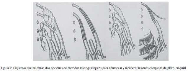 Opciones de métodos microquirúrgicos Opciones de métodos microquirúrgicos