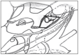 Triàngulo medial o trígono oculomotor