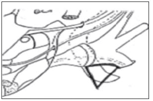 Triangulo postero de glasscock Triangulo postero de glasscock