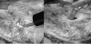 Lesión térmica y perforación en la mucosa esofágica