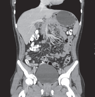 Escanografía abdominopélvica, en que se descartan alteraciones vasculares