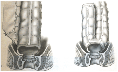 Anastomosis colo-anal directa 