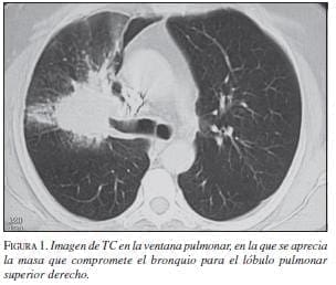 Imagen de TC en la Ventana Pulmonar
