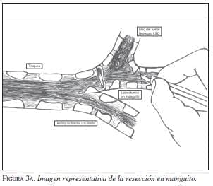 Imagen Representativa de la Resección en Manguito Imagen Representativa de la Resección en Manguito