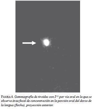 Gammagrafia de Tiroides Gammagrafia de Tiroides