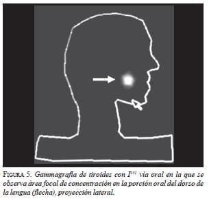 Gammagrafia de Tiroides Gammagrafia de Tiroides