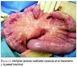 Multiples Lesiones Nodulares Multiples Lesiones Nodulares