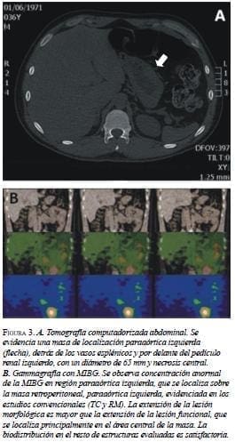 Tomografía Computarizada Abdominal 