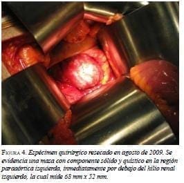 Espécimen Quirúrgico Resecado Hilio Renal