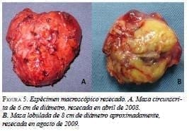 Espécimen Macroscópico Resecado Espécimen Macroscópico Resecado