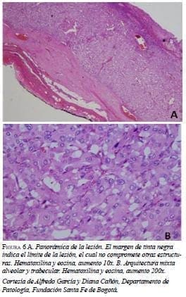 Panorámica Lesión Órgano de Zuckerkandl Panorámica Lesión Órgano de Zuckerkandl