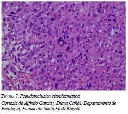 Pseudoinclusión Citoplasmática Pseudoinclusión Citoplasmática