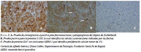 Prueba del Cromogranina del Órgano de Zuckerkandl Prueba del Cromogranina del Órgano de Zuckerkandl