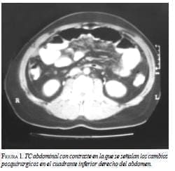 TC Abdominal con contraste en la que señalen los cambios posquirúrgicos