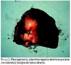 Pieza Operatoria Lobectomia Hepática