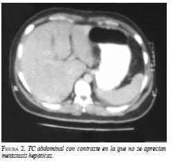 TC Abdominal con contraste en la que no se aprecian Metástosis Hepáticas TC Abdominal con contraste en la que no se aprecian Metástosis Hepáticas
