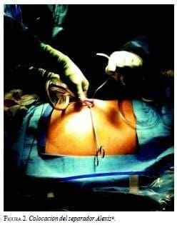 Colocación del separador Alexis Colocación del separador Alexis