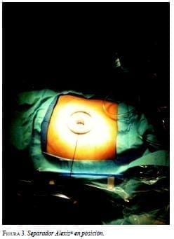 Separador Alexis en posición Separador Alexis en posición